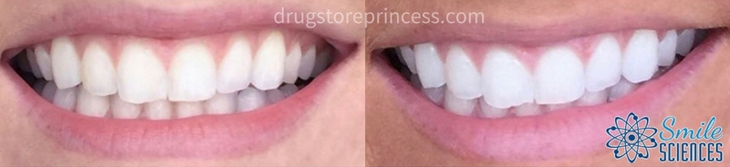 Smile Sciences Teeth Whitening Kit Review